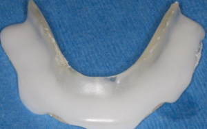 acrylic added for molar support of bite splint